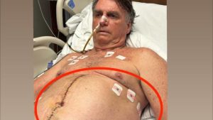 Explosivo! Bolsonaro Revela Detalhes CHOCANTES de Sua Cirurgia e Causa Revolta nas Redes!