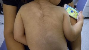 Minoxidil em Bebês: Anvisa Lança Alerta Chocante sobre Crescimento de Pelos!