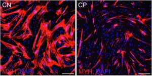 Revolução Científica: RNA Circular Poderia Transformar o Desenvolvimento Muscular em Pacientes com Paralisia Cerebral!