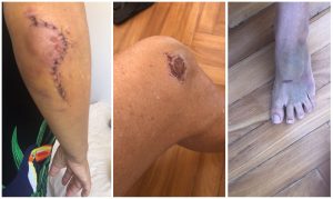 Choque no Rio: Aposentada Atropelada por Patinete na Contramão! Despesas de R$ 13 MIL e Impunidade Escandalosa!